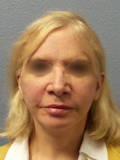 Facelift Before & After Patient #916