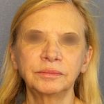 Facelift Before & After Patient #916
