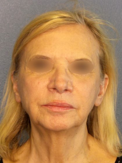 Facelift Before & After Patient #916