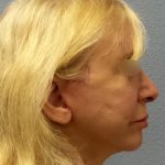 Facelift Before & After Patient #916
