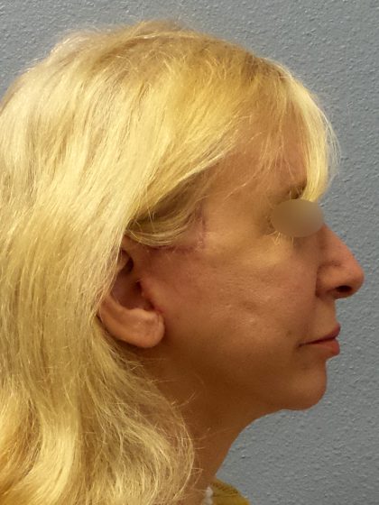 Facelift Before & After Patient #916