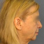 Facelift Before & After Patient #916