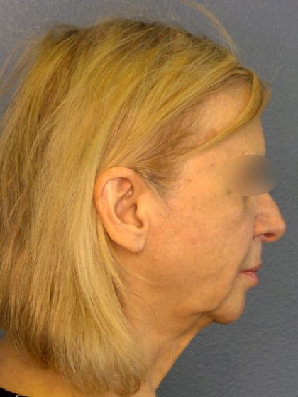 Facelift Before & After Patient #916