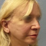 Facelift Before & After Patient #916