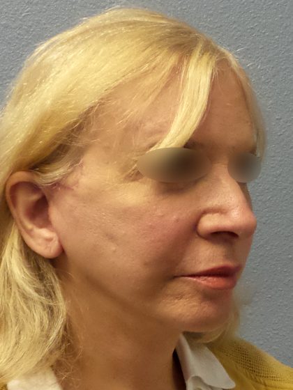 Facelift Before & After Patient #916