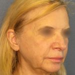 Facelift Before & After Patient #916