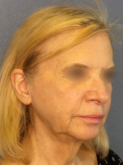 Facelift Before & After Patient #916