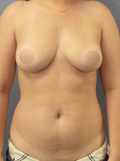 Breast Augmentation Before & After Patient #1668