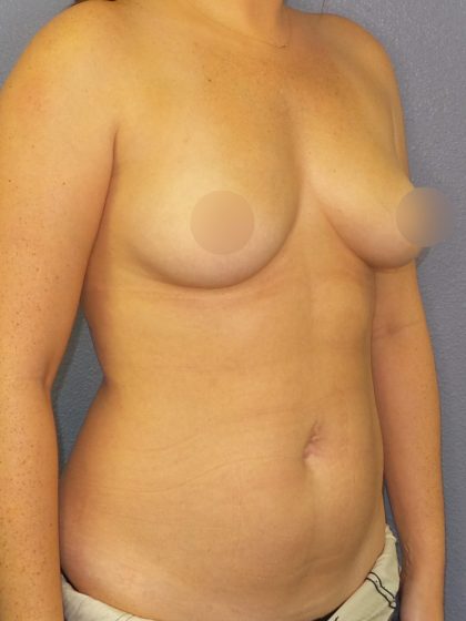 Breast Augmentation Before & After Patient #1668