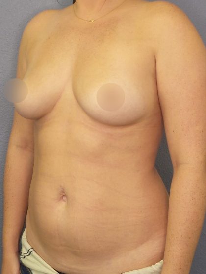 Breast Augmentation Before & After Patient #1668