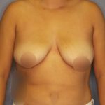Breast Augmentation Before & After Patient #1433