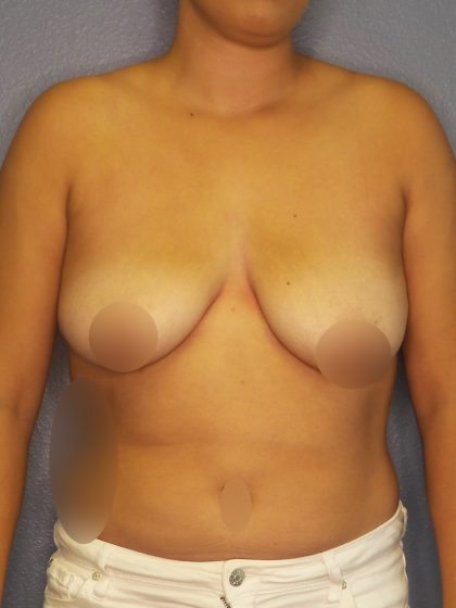 Breast Augmentation Before & After Patient #1433