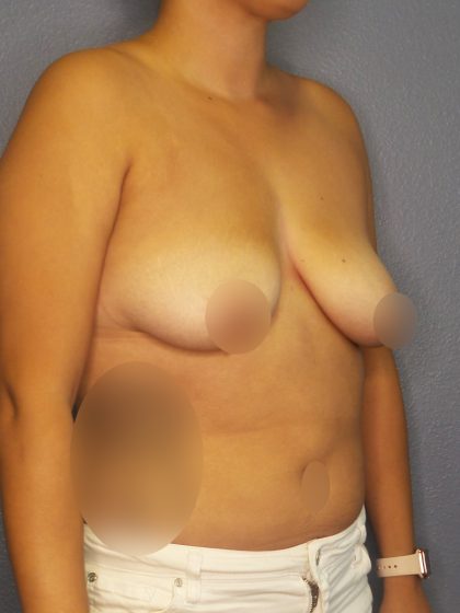 Breast Augmentation Before & After Patient #1433