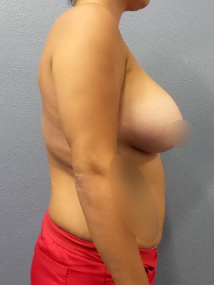 Breast Augmentation Before & After Patient #1433