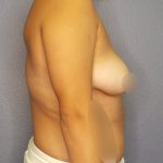 Breast Augmentation Before & After Patient #1433