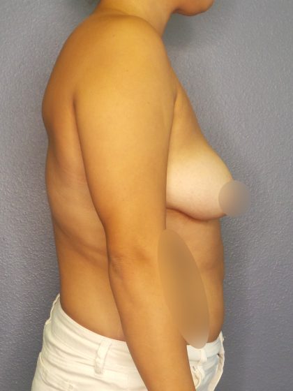 Breast Augmentation Before & After Patient #1433