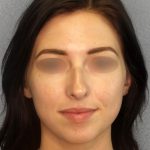 Revision Rhinoplasty Before & After Patient #318