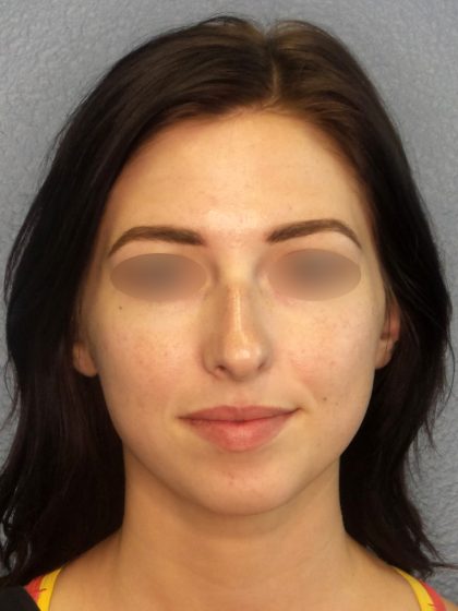 Revision Rhinoplasty Before & After Patient #318