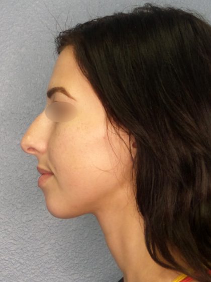Revision Rhinoplasty Before & After Patient #318