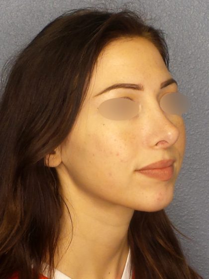 Revision Rhinoplasty Before & After Patient #318