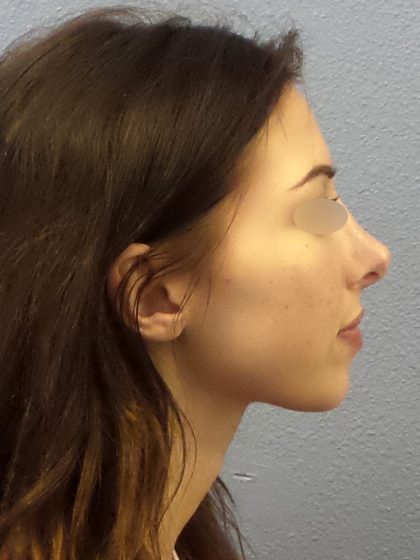 Revision Rhinoplasty Before & After Patient #318