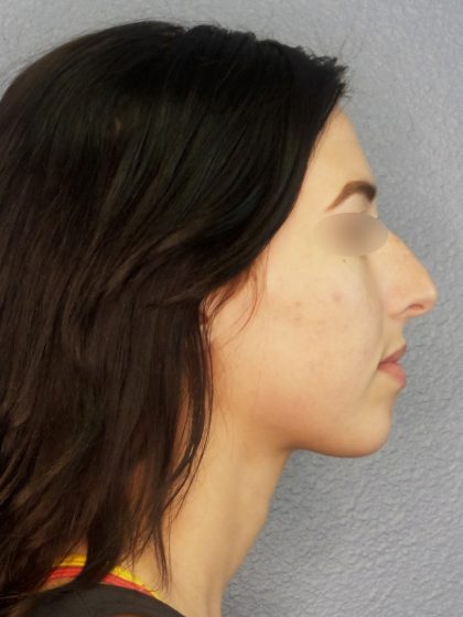 Revision Rhinoplasty Before & After Patient #318