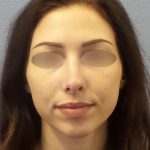 Rhinophyma Before & After Patient #1387