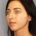 Rhinophyma Before & After Patient #1387
