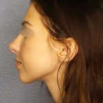 Rhinophyma Before & After Patient #1387