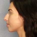 Rhinophyma Before & After Patient #1387