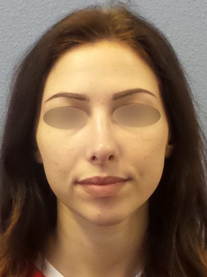 Rhinoplasty Before & After Patient #576