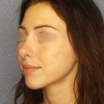 Rhinoplasty Before & After Patient #576