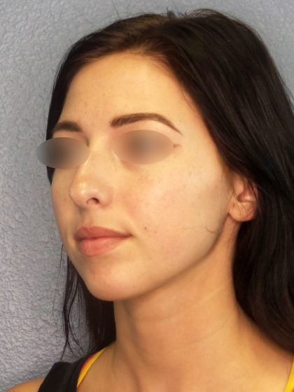 Rhinoplasty Before & After Patient #576