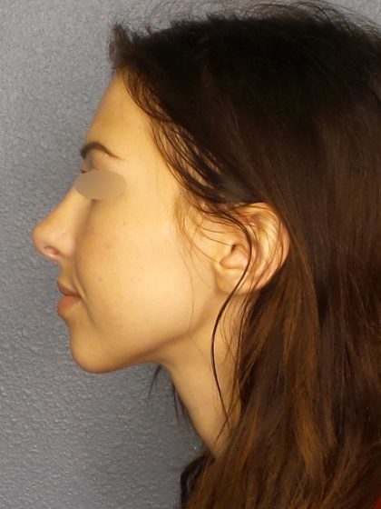 Rhinoplasty Before & After Patient #576