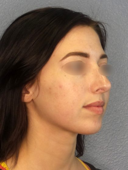 Rhinoplasty Before & After Patient #576