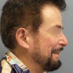 Liposuction of the Neck Before & After Patient #444