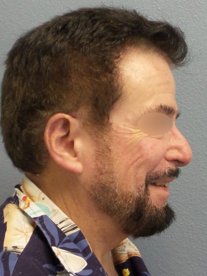 Liposuction of the Neck Before & After Patient #444