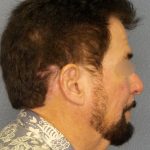 Liposuction of the Neck Before & After Patient #444