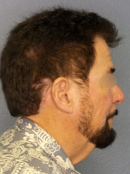 Liposuction of the Neck Before & After Patient #444
