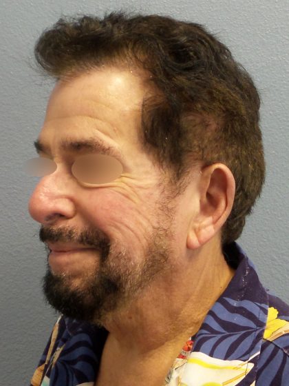 Liposuction of the Neck Before & After Patient #444
