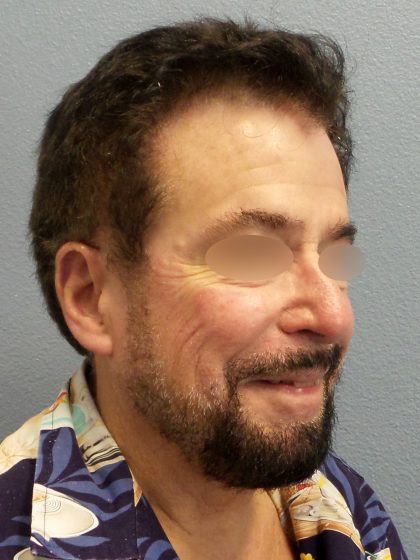 Liposuction of the Neck Before & After Patient #444