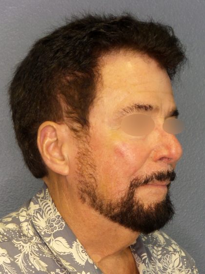 Liposuction of the Neck Before & After Patient #444