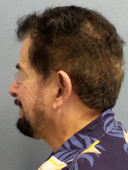 Liposuction of the Neck Before & After Patient #444