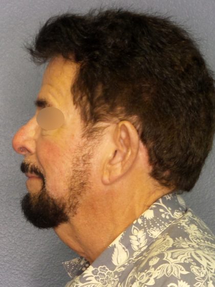Liposuction of the Neck Before & After Patient #444