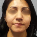 Revision Rhinoplasty Before & After Patient #231