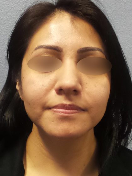 Revision Rhinoplasty Before & After Patient #231