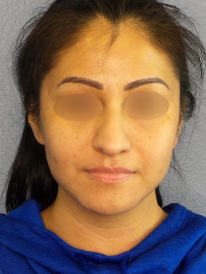 Revision Rhinoplasty Before & After Patient #231