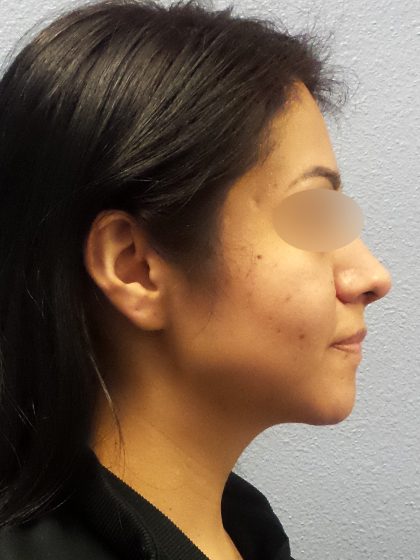 Revision Rhinoplasty Before & After Patient #231