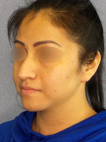 Revision Rhinoplasty Before & After Patient #231