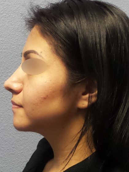 Revision Rhinoplasty Before & After Patient #231